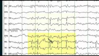 Pediatric EEG – What to Expect [upl. by Leorsiy]