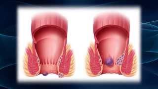 Hurting From Hemorrhoids [upl. by Gargan]