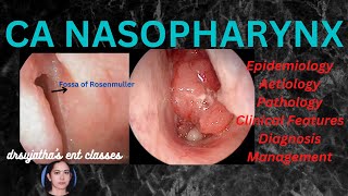 199Nasopharyngeal Carcinoma Part 13 epidemiology aetiologyclinical features nasopharynx [upl. by Adnalahs]