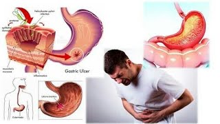 What is a gastritis causes of gastritis gestritis Animation 3d video gastritis  cardiac tech [upl. by Kerred]