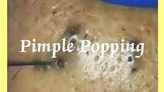 Pimple amp Blackheads Popping  46 [upl. by Iey]