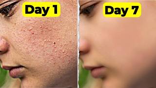 7 Days Clear Skin Challenge With Home Remedies  Clear Tiny Bumps from Forehead amp Face [upl. by Pederson]