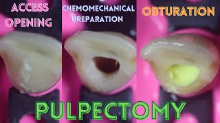 Access Opening ⚪️ Chemomechanical Preparation 🟢 Obturation 🟡 Pulpectomy 🟠 Primary Central Incisor [upl. by Sualokcin]