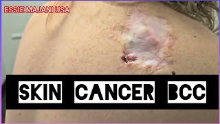 Skin Cancer misdiagnosed Basal Cell Carcinoma 😞😢 [upl. by Notsle]