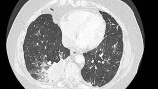 Right lower lobe pneumonia [upl. by Letitia]