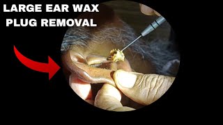 LARGE EAR WAX PLUG REMOVAL [upl. by Sitnik]