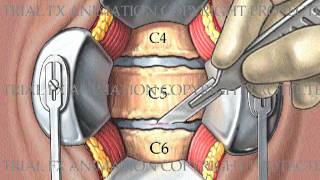 2 Level Cervical Arthrodesis with ProDiscC [upl. by Wilden]