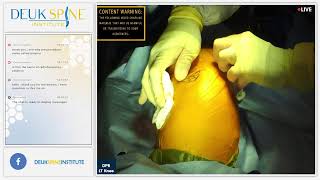 Deuk Plasma Rhizotomy DPR for Knee Pain [upl. by Oicnoel410]