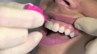 How to use an interdental brush  AJ Hedger [upl. by Eisac810]