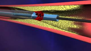 ASPIRE Mechanical Thrombectomy System [upl. by Ferrell]