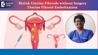 Treat Uterus Fibroid without Surgery Uterine Fibroid EmbolizationDrRohit MadhukarDoctors Circle [upl. by Jacky]