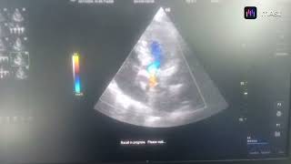 DEGENERATIVE CALCIFIC MODERATE AS MILD AR NORMAL LV DILATED LA [upl. by Marthe]