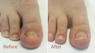 Unghia incarnata  The ingrown toenail  Before amp After [upl. by Naig101]