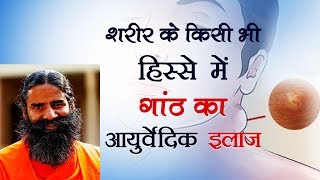 शरीर के किसी भी हिस्से में गांठ का आयुर्वेदिक इलाज  Swami Ramdev [upl. by Kristian]