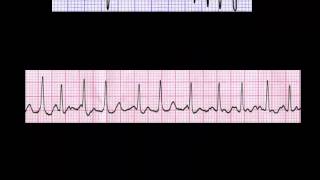 CURSO DE ELECTROCARDIOGRAFIA 24  AUTOEVALUACIÓN SOBRE MEDICIÓN DE FRECUENCIA [upl. by Eli]