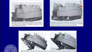 DENT 718 Rotational path partial dentures [upl. by Shumway]