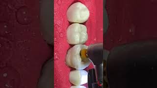 Small Cavity Big DAMAGE rootcanaltreatment [upl. by Kayle]