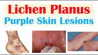 Lichen Planus “Purple Skin Lesions”  Causes Signs amp Symptoms Diagnosis Treatment [upl. by Cornelie]