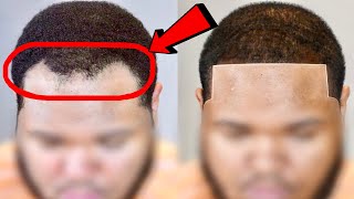 AMAZING Hairline Transformation RECEDING Hairline Restoration [upl. by Ellenahc]