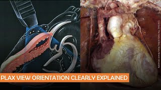 Parasternal long axis echocardiographic view anatomy POCUS pearls  Dr Koratala [upl. by Aihsenot]