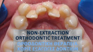 Nonextraction orthodontic treatment Pt BE [upl. by Warrick]