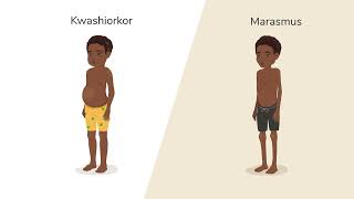 What is Malnutrition [upl. by Sira]