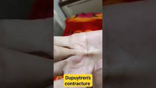 Dupuytrens contracture in chronic liver disease patientidentifydiagnosisliverdisease [upl. by Bryna707]