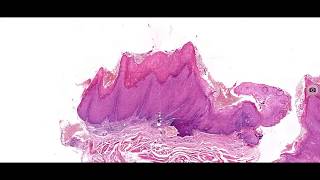 Hyperplasia and Hyperkeratosis [upl. by Hsekar455]