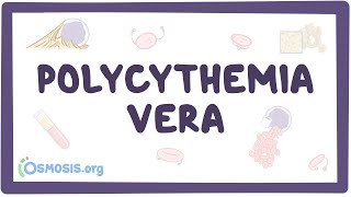 Polycythemia vera  causes symptoms diagnosis treatment pathology [upl. by Lebazi]