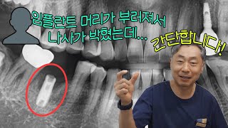 임플란트 후 탈이 났을 경우 치료법은 의외로 간단합니다 [upl. by Sudhir]