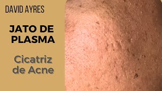 Tratamento para cicatriz de acne com Jato de Plasma [upl. by Nnire]