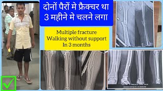 tibia fibula femur multiple fracture recovery in 3 months walking ACLLigamentFractureIlizarov [upl. by Drucie817]