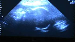 31 weeks ultrasound [upl. by Norod29]