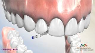 Interproximal Reduction or IPR  Polishing Strip [upl. by Zoi]