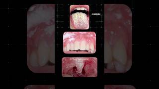 வாயில் ஏற்படும் பூஞ்சை தொற்று Oral Thrush Dr Isacc Abbas [upl. by Eneleh696]