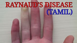 Raynauds disease in tamil class medics [upl. by Neerbas]