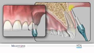 Supraperiosteal Injection [upl. by Turpin]