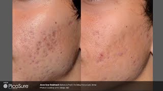 Laser Acne Scar Removal  Pulse light Clinic London [upl. by Wurtz688]