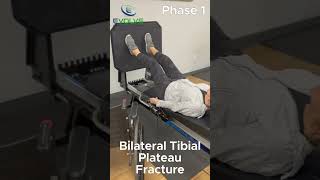 A Crucial Exercise to Perform When Introducing WeightBearing After a Tibial Plateau Fracture [upl. by Ainoyek]