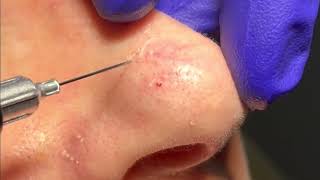 Telangiectasia Treatment on the Nose by Dr Brandon Beal [upl. by Montgomery728]