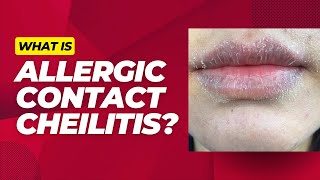 What is allergic contact cheilitis [upl. by Coster126]