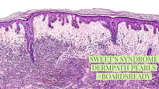 Sweet’s disease explained by a dermatopathologist Unk 16 [upl. by Bay]