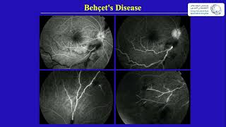 Behcets Disease [upl. by Vish]