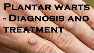 Plantar warts  Diagnosis and treatment [upl. by Arlynne]