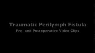 Perilymph Fistula [upl. by Kamaria]