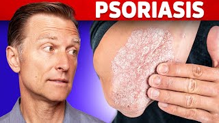 Psoriasis Treatment – The Best 3 Remedies for Psoriasis – DrBerg [upl. by Eibob]