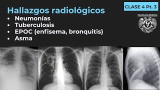 043  Neumonía TB EPOC Enfisema Bronquitis Bronquiectasias Asma [upl. by Gadmann]