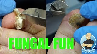 EXTREME BAD NAIL FUNGUS TREATMENT 1  FOOT HEALTH MONTH 2018 17 [upl. by Lachus]