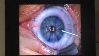 Opération lasik des yeux pour corriger les défauts visuels [upl. by Gibby]