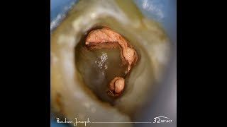 47 C shaped canal  rapid flow obturation [upl. by Annaiviv]